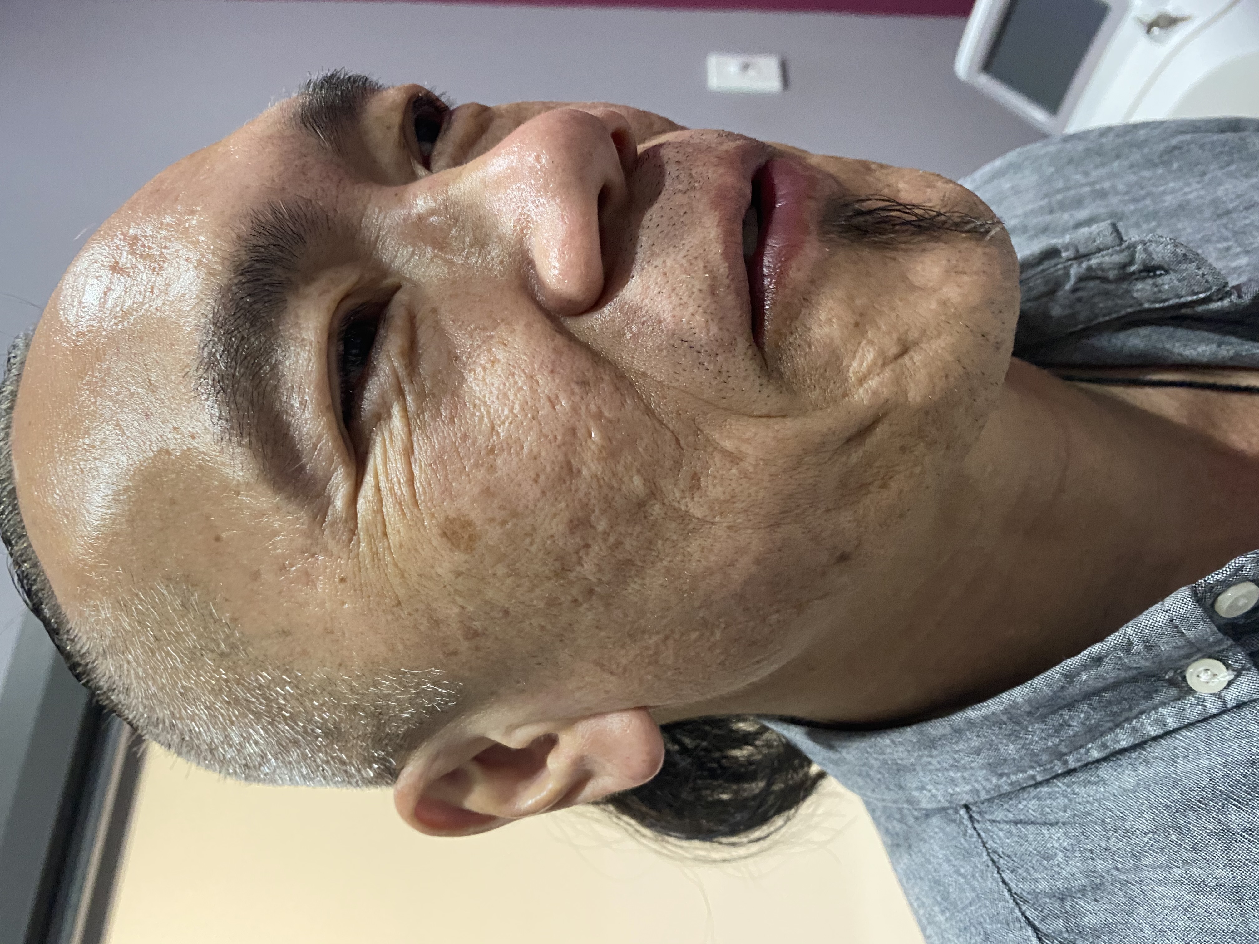 CO2 and RF Treatment Before